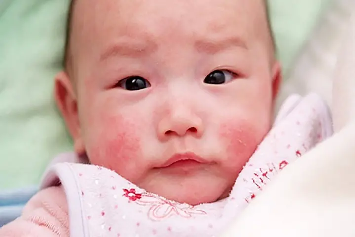 Dấu Hiệu Bé Dị Ứng Sữa Mẹ