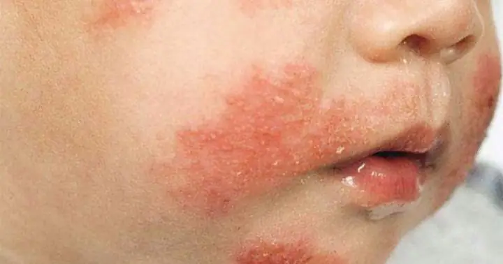 Dấu Hiệu Bé Dị Ứng Sữa Mẹ