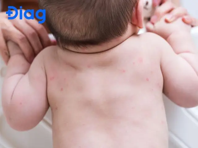 Dấu Hiệu Bé Dị Ứng Sữa Mẹ