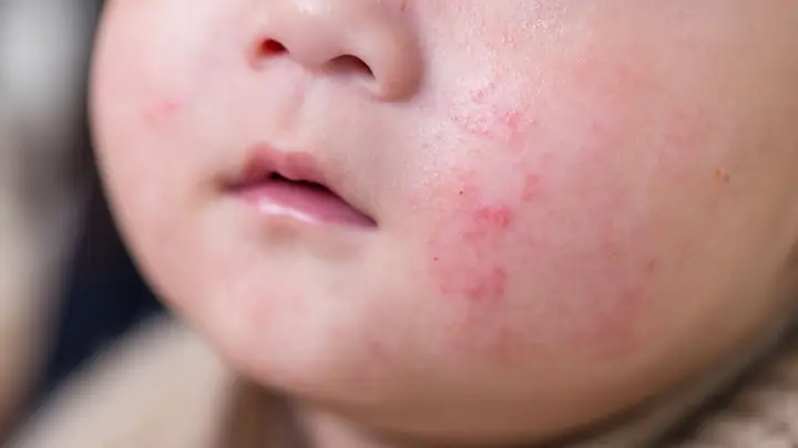 Dấu Hiệu Bé Dị Ứng Sữa Mẹ
