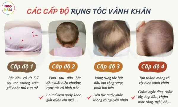 Dấu Hiệu Của Trẻ Thiếu Canxi