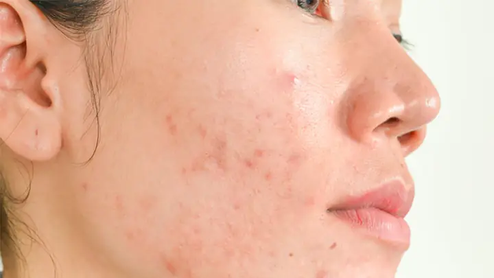 Dấu Hiệu Da Không Hợp Mỹ Phẩm