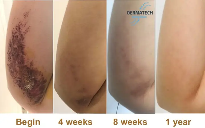 Dầu Mù U Trị Bỏng Bô