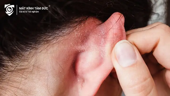 Đeo Kính Bị Đau Vành Tai