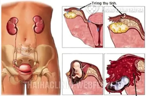 Đi Ngoài Nhiều Có Phải Dấu Hiệu Mang Thai