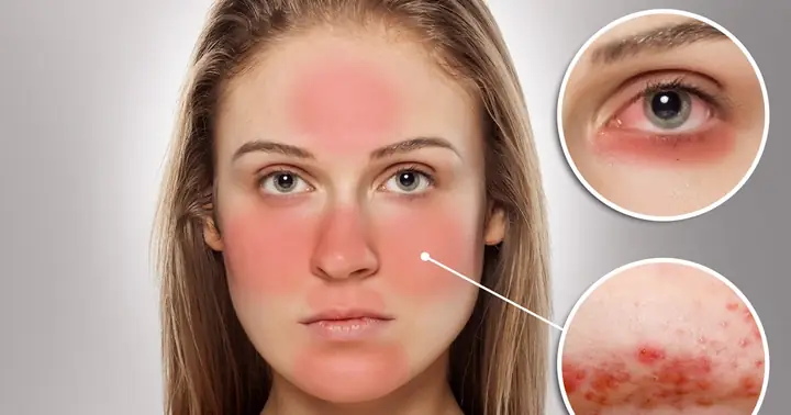 Dị Ứng Mặt Nạ Sữa Chua Dị Ứng Mặt Nạ Sữa Chua
