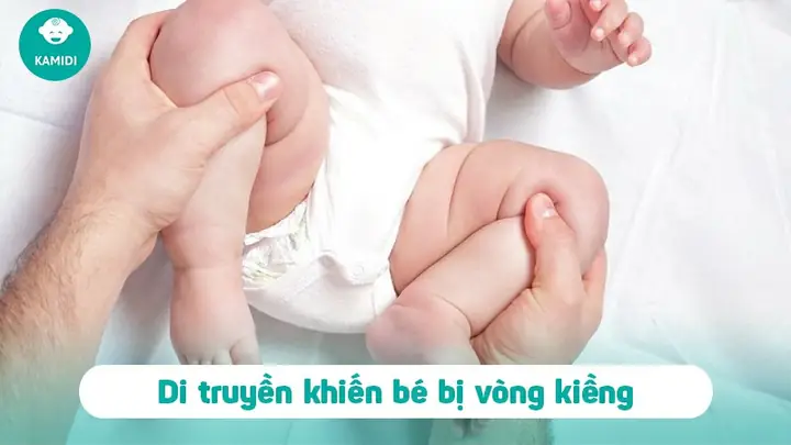 Đóng Bỉm Cho Trẻ Sơ Sinh Có Bị Vòng Kiềng Đóng Bỉm Cho Trẻ Sơ Sinh Có Bị Vòng Kiềng