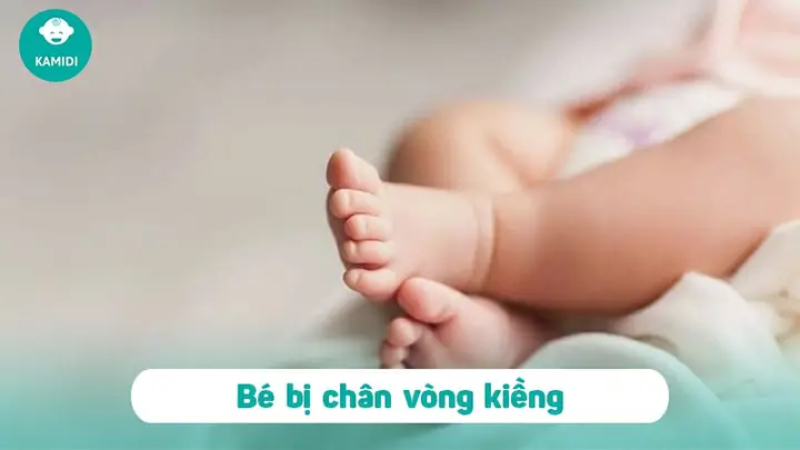 Đóng Bỉm Cho Trẻ Sơ Sinh Có Bị Vòng Kiềng Đóng Bỉm Cho Trẻ Sơ Sinh Có Bị Vòng Kiềng