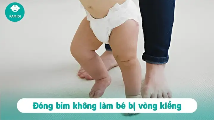 Đóng Bỉm Cho Trẻ Sơ Sinh Có Bị Vòng Kiềng
