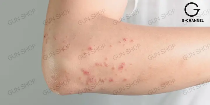 Dùng Bao Cao Su Có Bị Vô Sinh Không