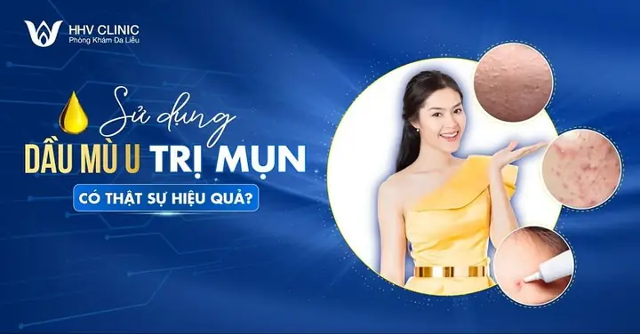 Dùng Dầu Mù U Trị Mụn