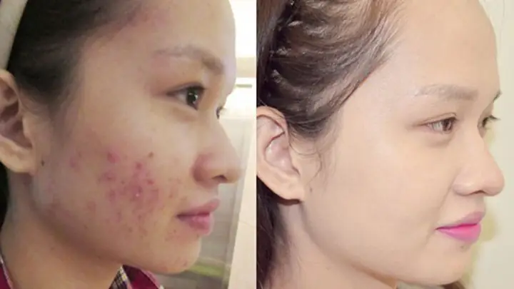 Dùng Dầu Mù U Trị Mụn