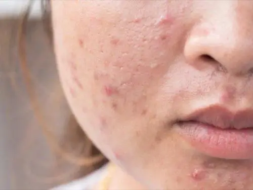 Dùng Kem Dưỡng Ẩm Bị Lên Mụn