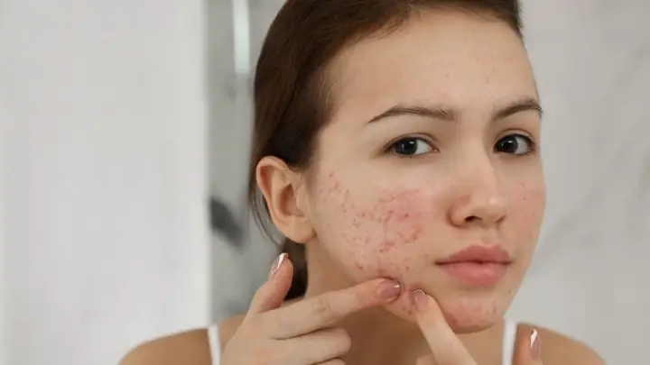 Dùng Kem Dưỡng Da Bị Nổi Mụn
