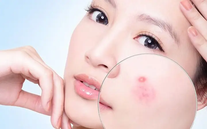 Dùng Kem Dưỡng Da Bị Nổi Mụn