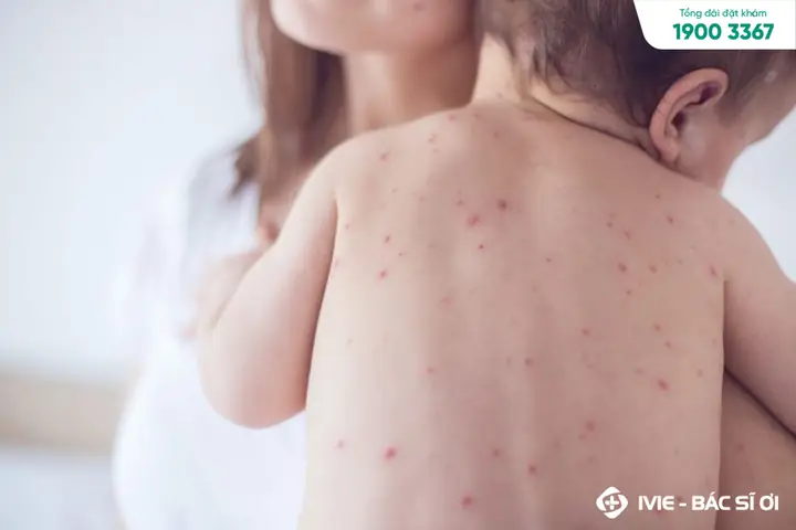 Em Bé Bị Nổi Chấm Đỏ Trên Mặt