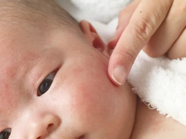 Em Bé Bị Nổi Chấm Đỏ Trên Mặt