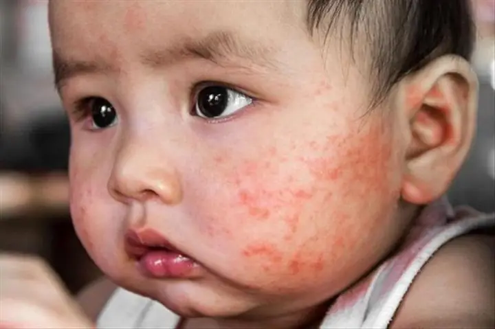 Em Bé Nổi Mẩn Đỏ Trên Mặt Em Bé Nổi Mẩn Đỏ Trên Mặt