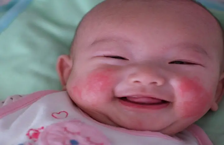 Em Bé Nổi Mẩn Đỏ Trên Mặt Em Bé Nổi Mẩn Đỏ Trên Mặt