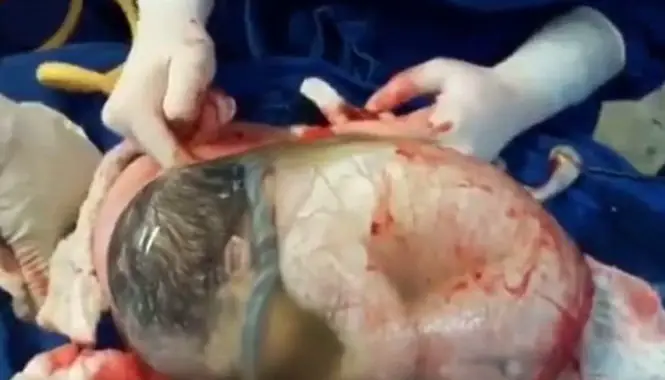 Em Bé Sinh Ra Còn Nguyên Trong Bọc