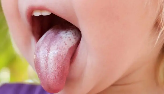 Gạc Rơ Lưỡi Loại Nào Tốt Gạc Rơ Lưỡi Loại Nào Tốt