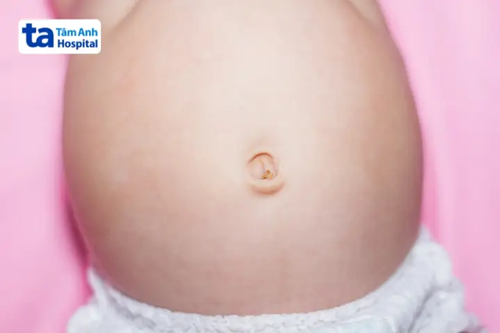 Hinh Anh Rụng Rốn Ở Trẻ Sơ Sinh