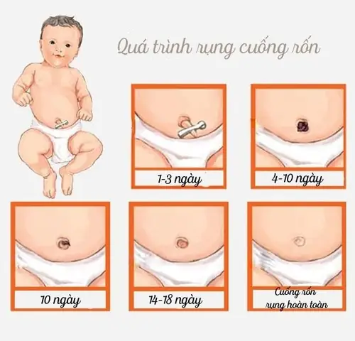 Hinh Anh Rụng Rốn Ở Trẻ Sơ Sinh