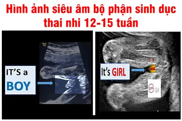 Hình Ảnh Siêu Âm Bé Trai 15 Tuần