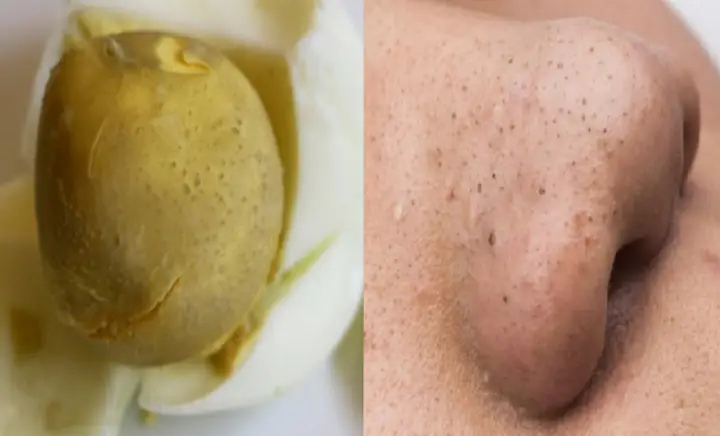 Hút Mụn Có Tác Dụng Gì