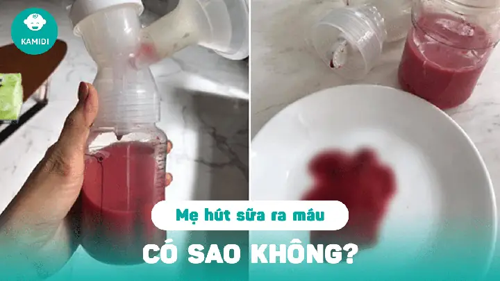 Hút Sữa Bằng Máy Bị Chảy Máu