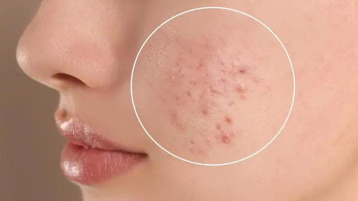 Kem Chống Nắng Gây Mụn Ẩn