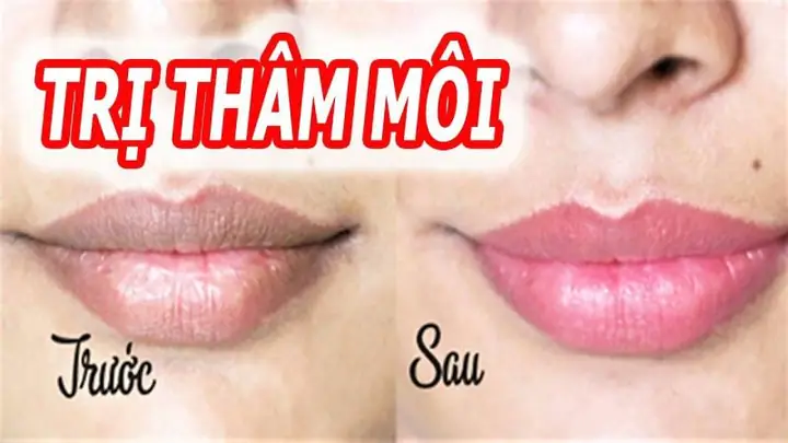 Kem Đánh Răng Có Trị Thâm Môi Không
