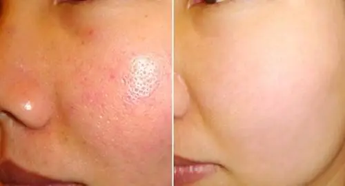 Kem Đánh Răng Giúp Se Khít Lỗ Chân Lông