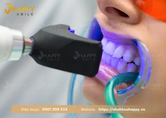 Kem Đánh Răng Smile Up Có Tốt Không