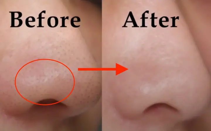 Kem Lột Mụn Đầu Đen Hiệu Quả