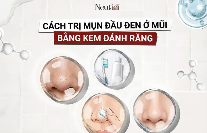 Kem Lột Mụn Đầu Đen Hiệu Quả