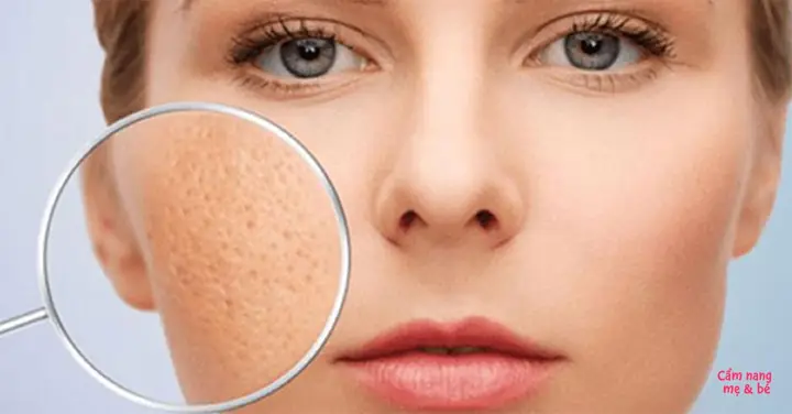 Kem Trị Lỗ Chân Lông To Trên Mặt