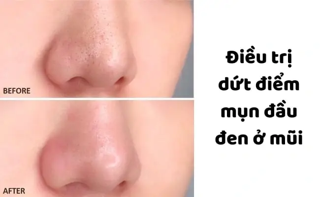 Kem Trị Mụn Cám Mụn Đầu Đen Kem Trị Mụn Cám Mụn Đầu Đen