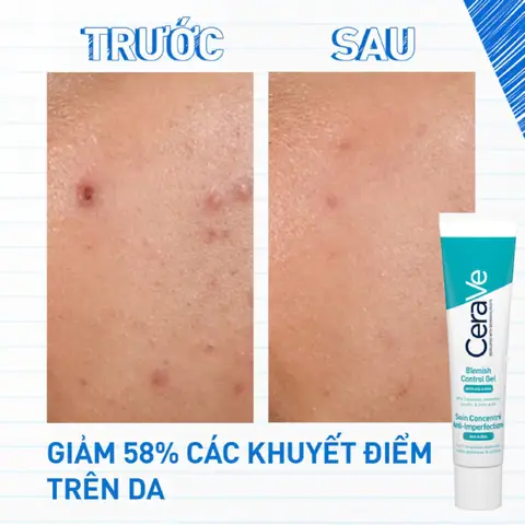 Kem Trị Mụn Rẻ Tiền Hiệu Quả
