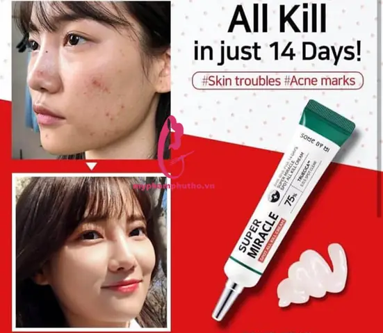 Kem Trị Mụn Some By Mi 14 Day Review