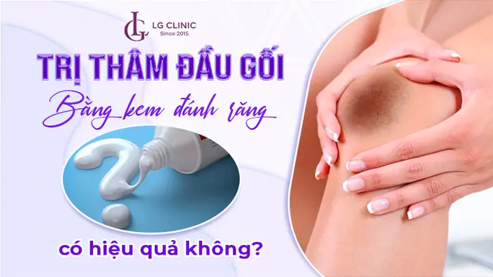 Kem Trị Thâm Đầu Gối Hiệu Quả