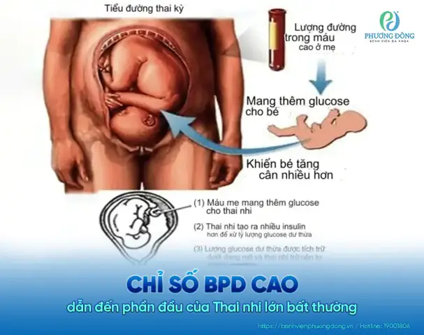 Ky Hieu Bpd Trong Sieu Am Thai La Gi Ky Hieu Bpd Trong Sieu Am Thai La Gi