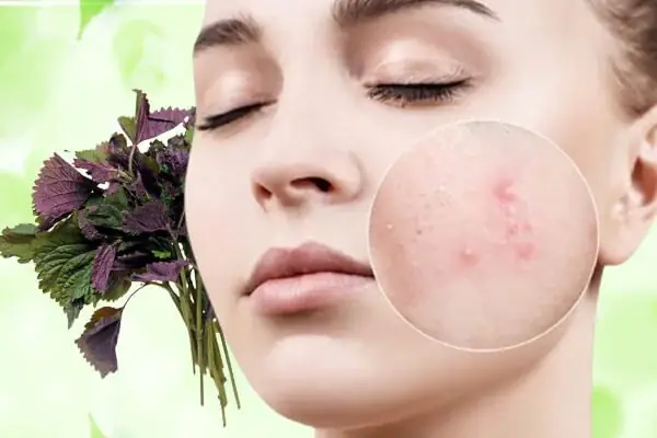 Lá Tía Tô Đắp Mặt Nạ
