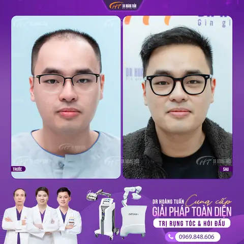 Là Tóc Giữ Được Bao Lâu