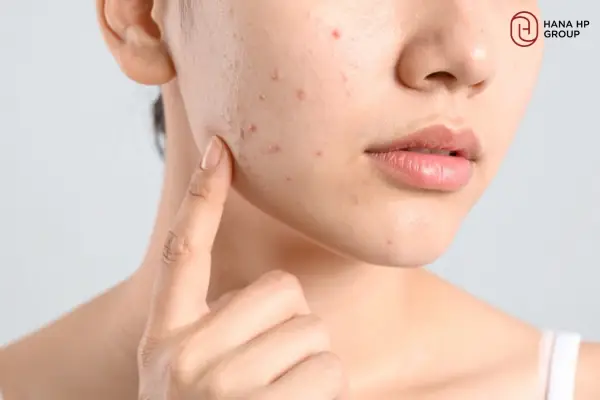 Làm Đẹp Bằng Rau Diếp Cá