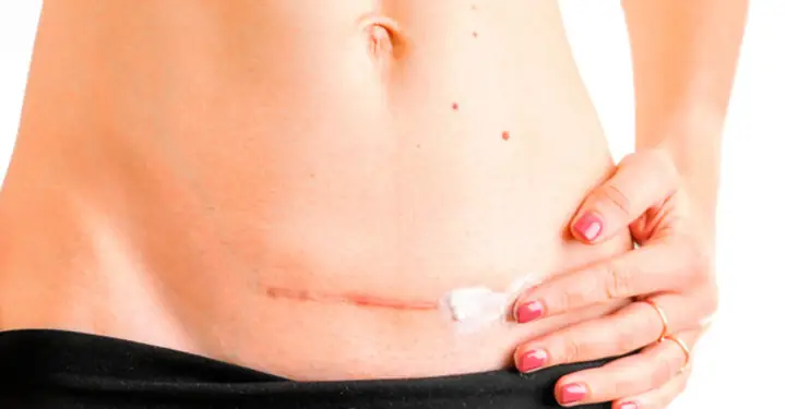 Làm Gì Để Bụng Nhỏ Sau Sinh Mổ