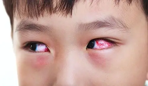 Làm Gì Khi Bé Bị Đau Mắt