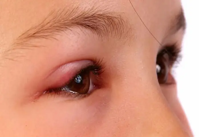 Làm Gì Khi Bé Bị Đau Mắt