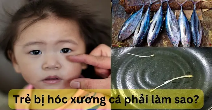Làm Gì Khi Bị Hóc Xương