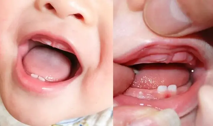 Làm Gì Khi Con Bú Môi
